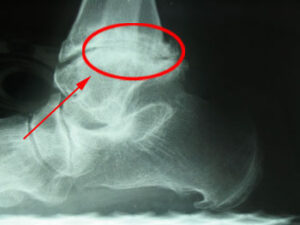 X ray of an arthritic ankle