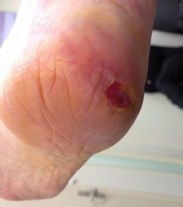A blister on the heel
