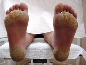 Feet with callouses