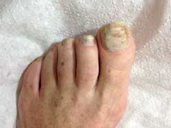 Fungal nail before treatment