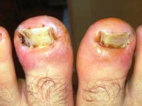 Ingrown Toenail Surgery - Buderim Podiatry