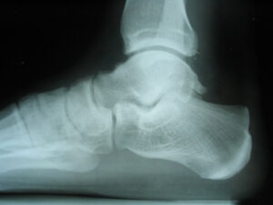 X ray of a normal ankle