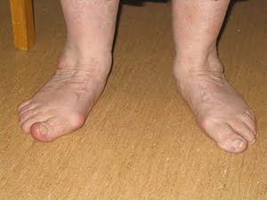 Front view of fallen arches or flat feet