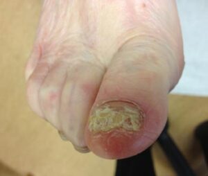 A fungal toenail