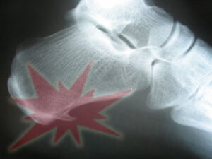 X ray of a heel spur