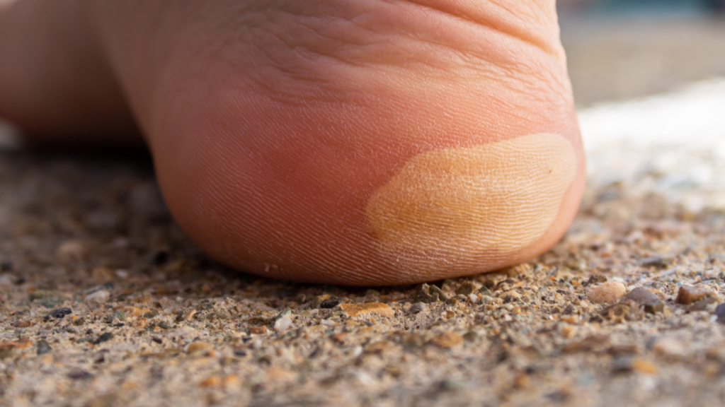 Waikato blisters heel