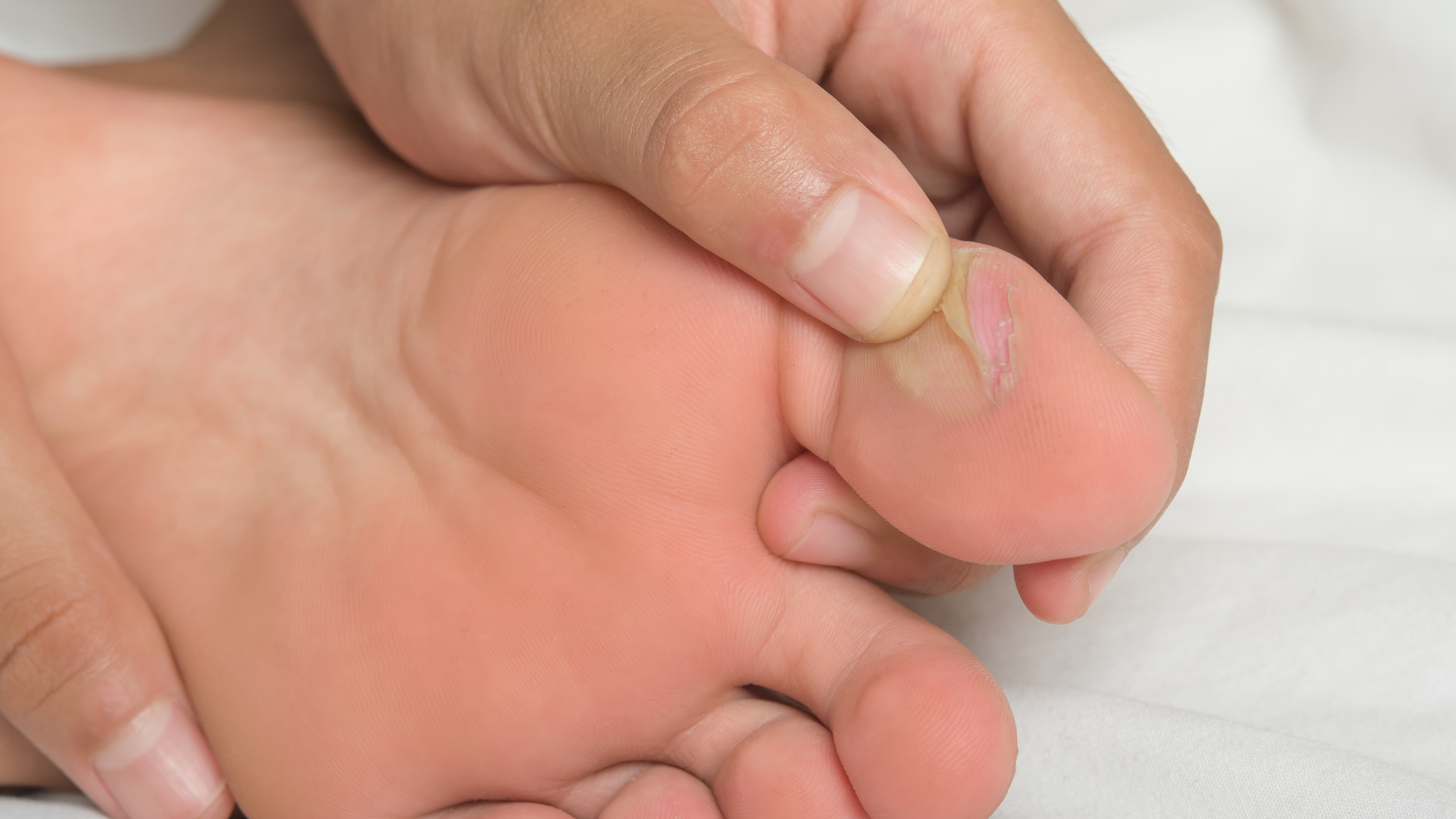 Waikato blisters toe