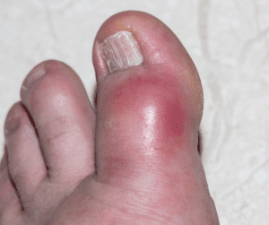 gout in toe gout in toe