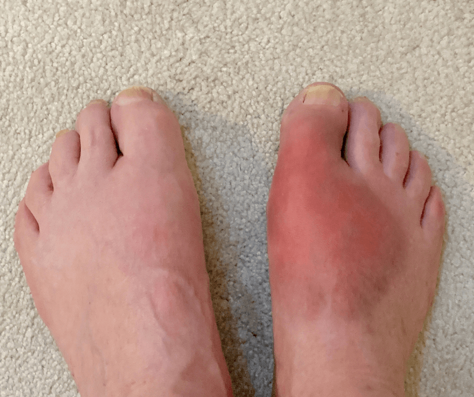 gout gout in feet