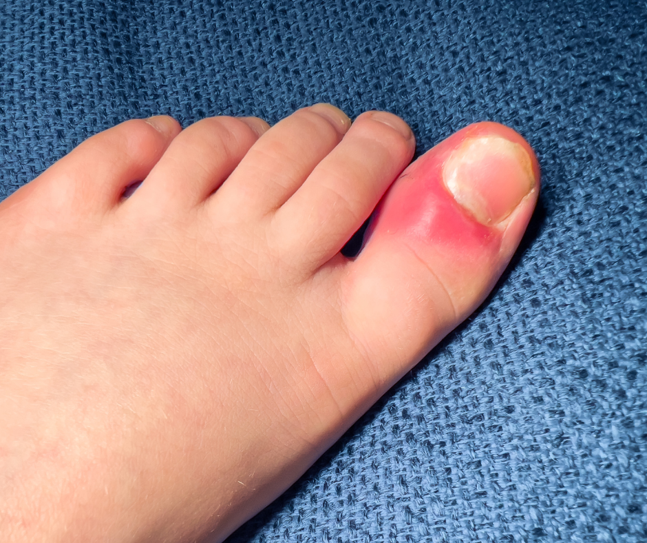 Ingrown toenails
