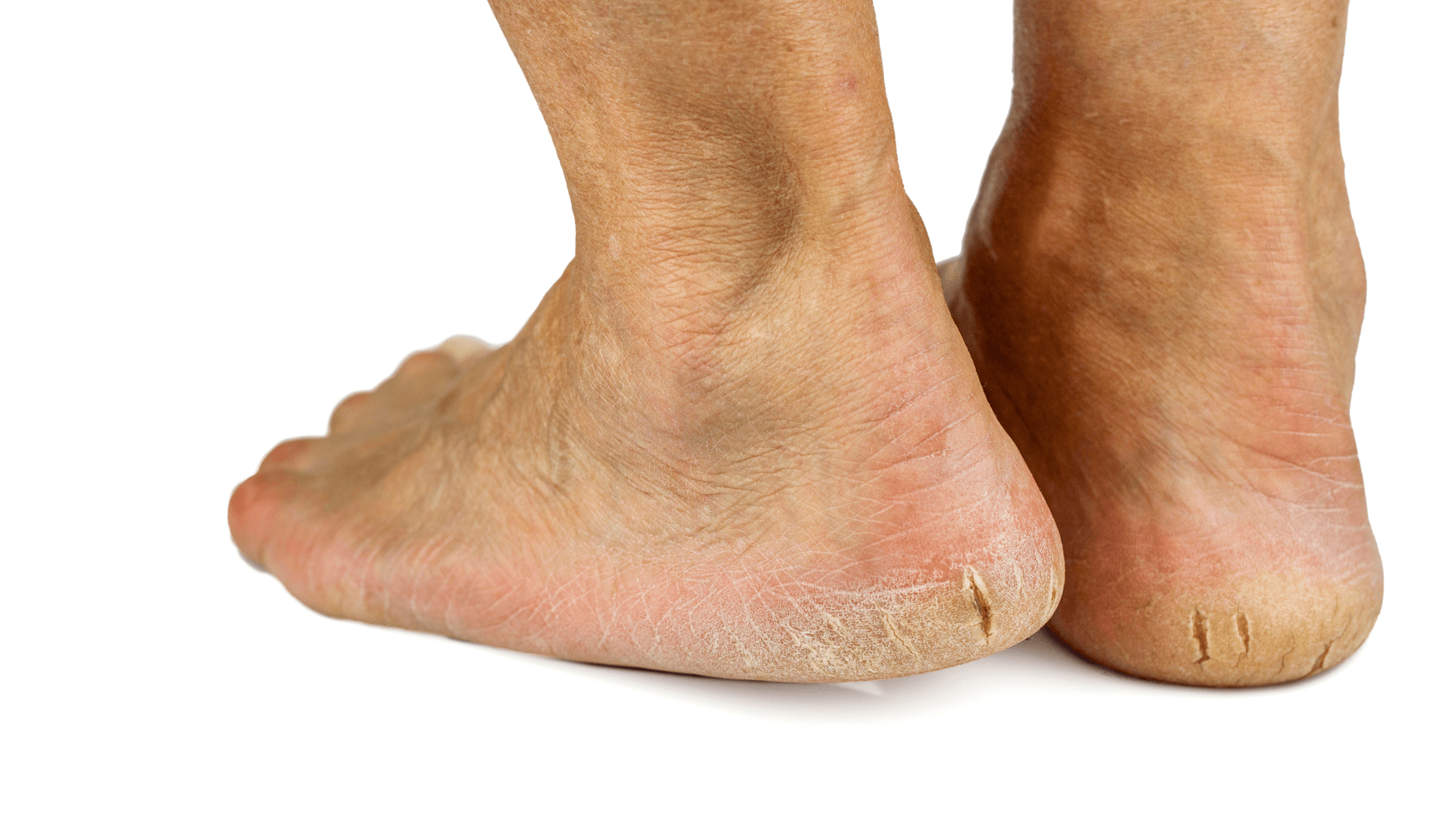 Cracked Heels Cracked Heels