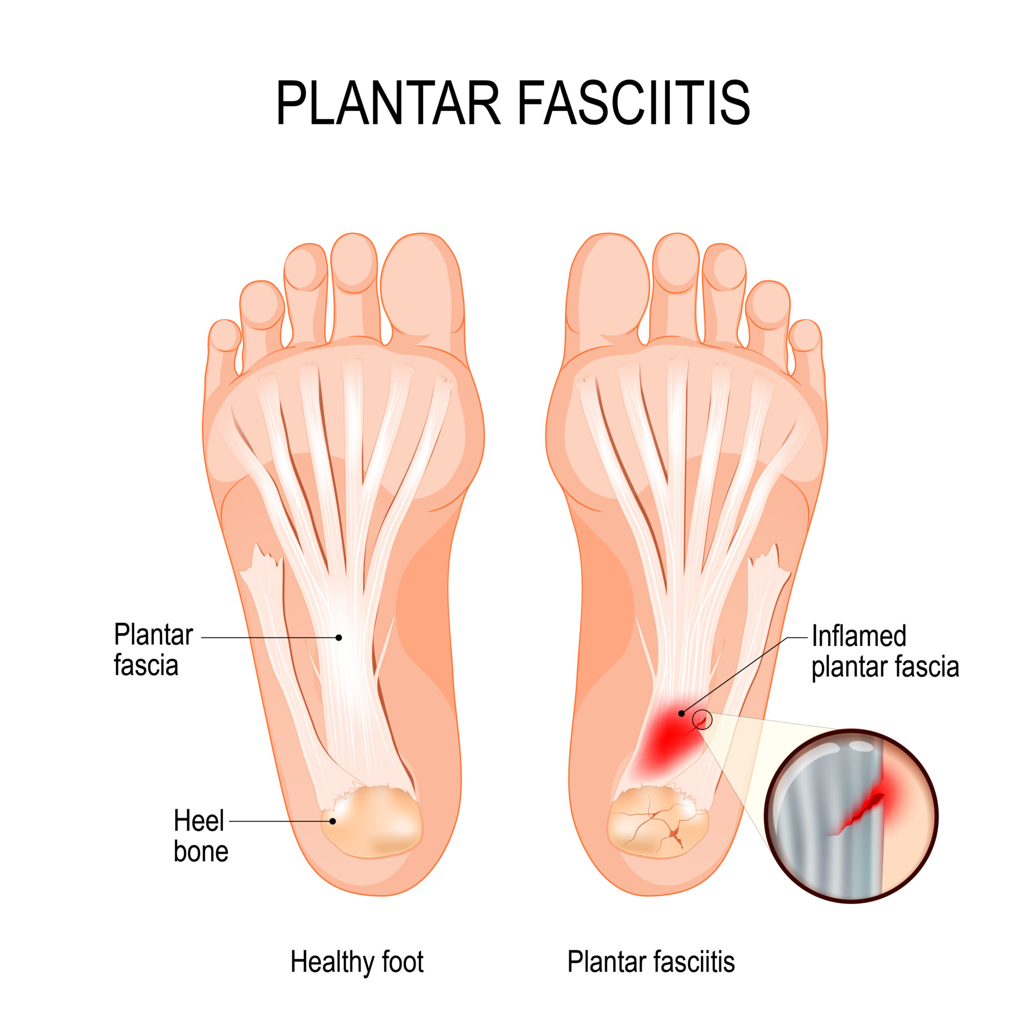 Plantar Fasciitis Treatments In Alappuzha | Prolotherapy for Heel Pain  Kerala
