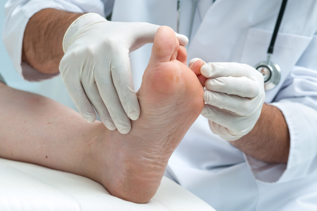 Fungal Foot Infection