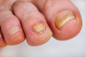 Fungal Foot Infection