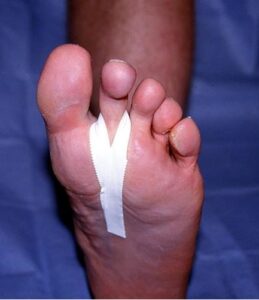 stirrup strapping for plantar plate injury