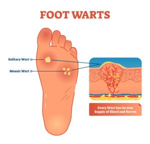 warts