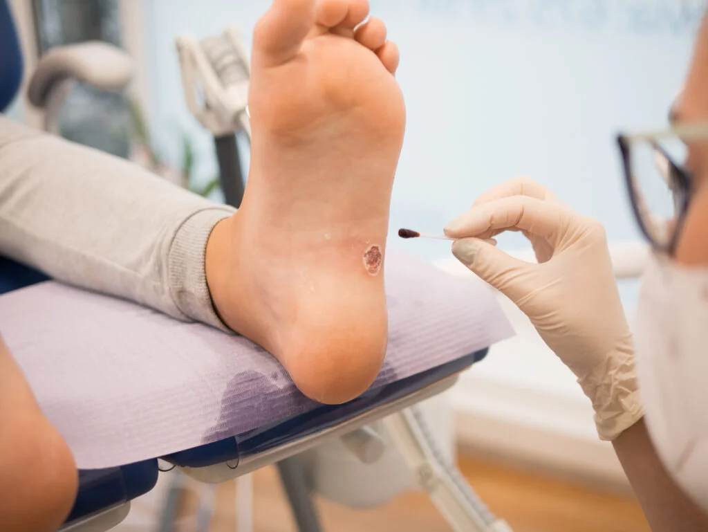 Warts - Let Us Help You! - Waikato Podiatry