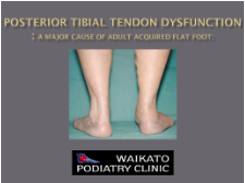 posterior-tibial-tendon-dysfunction-waikato-podiatry