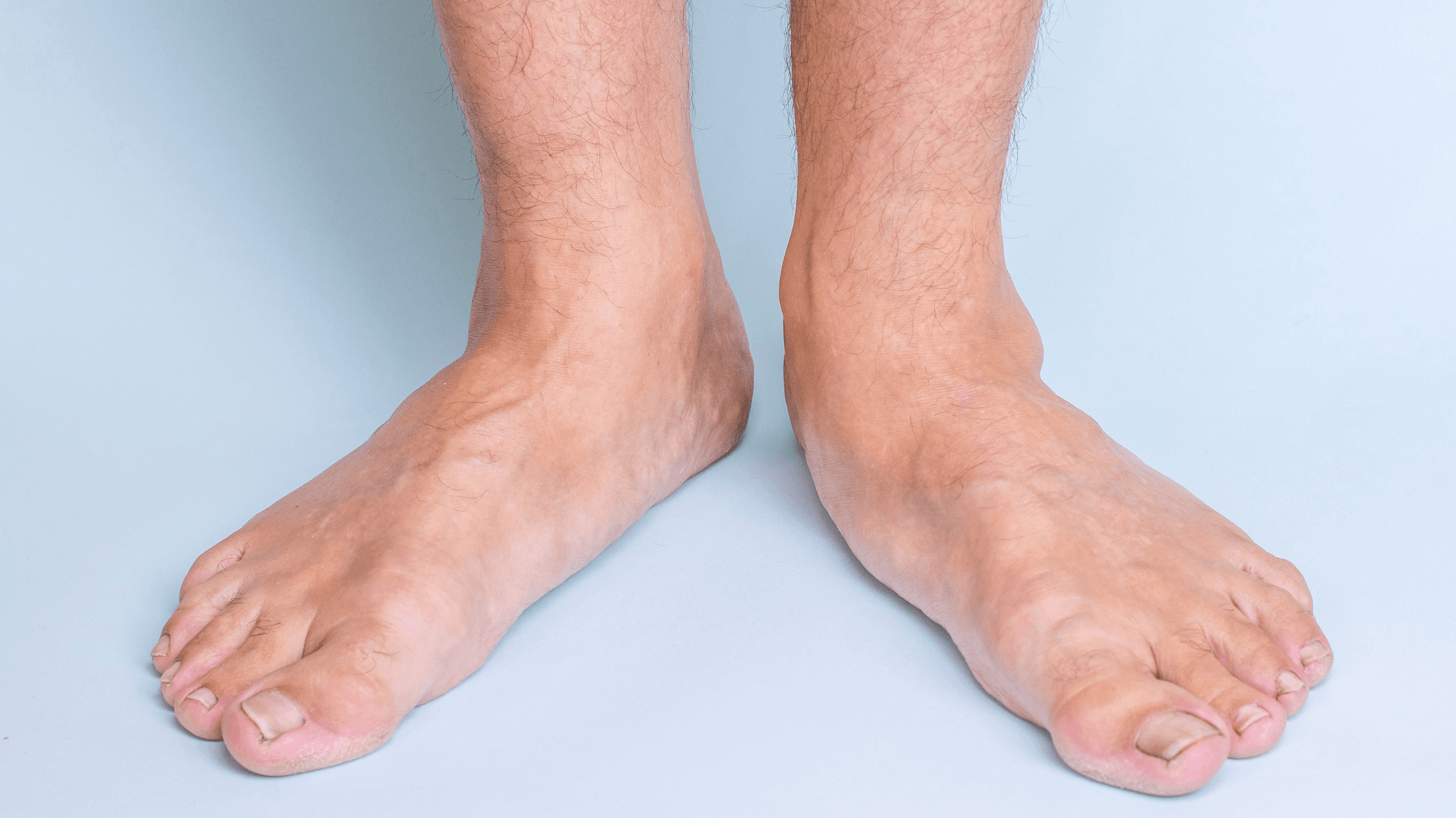 Flat feet PTTD foot pain