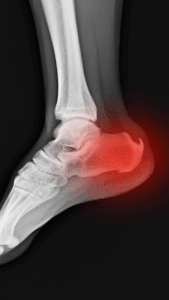 Heel spur causing foot pain