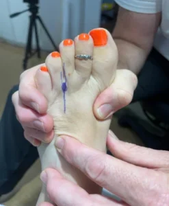 Mortons Neuroma