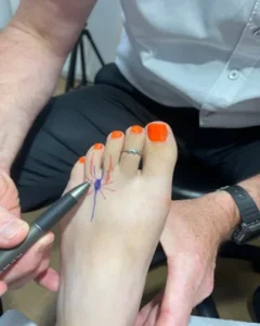 Mortons Neuroma