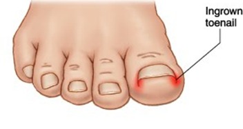 ingrown-toenail-surgery