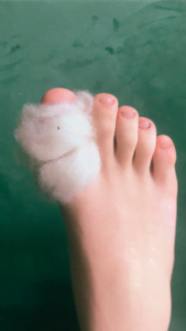Hikers wool around big toe
