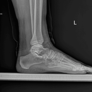 xray of the foot