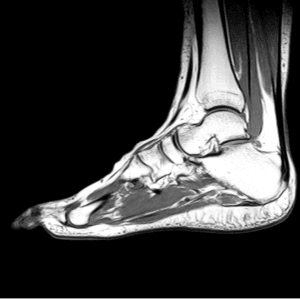 MRI of the foot