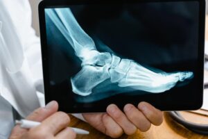 Foot xray