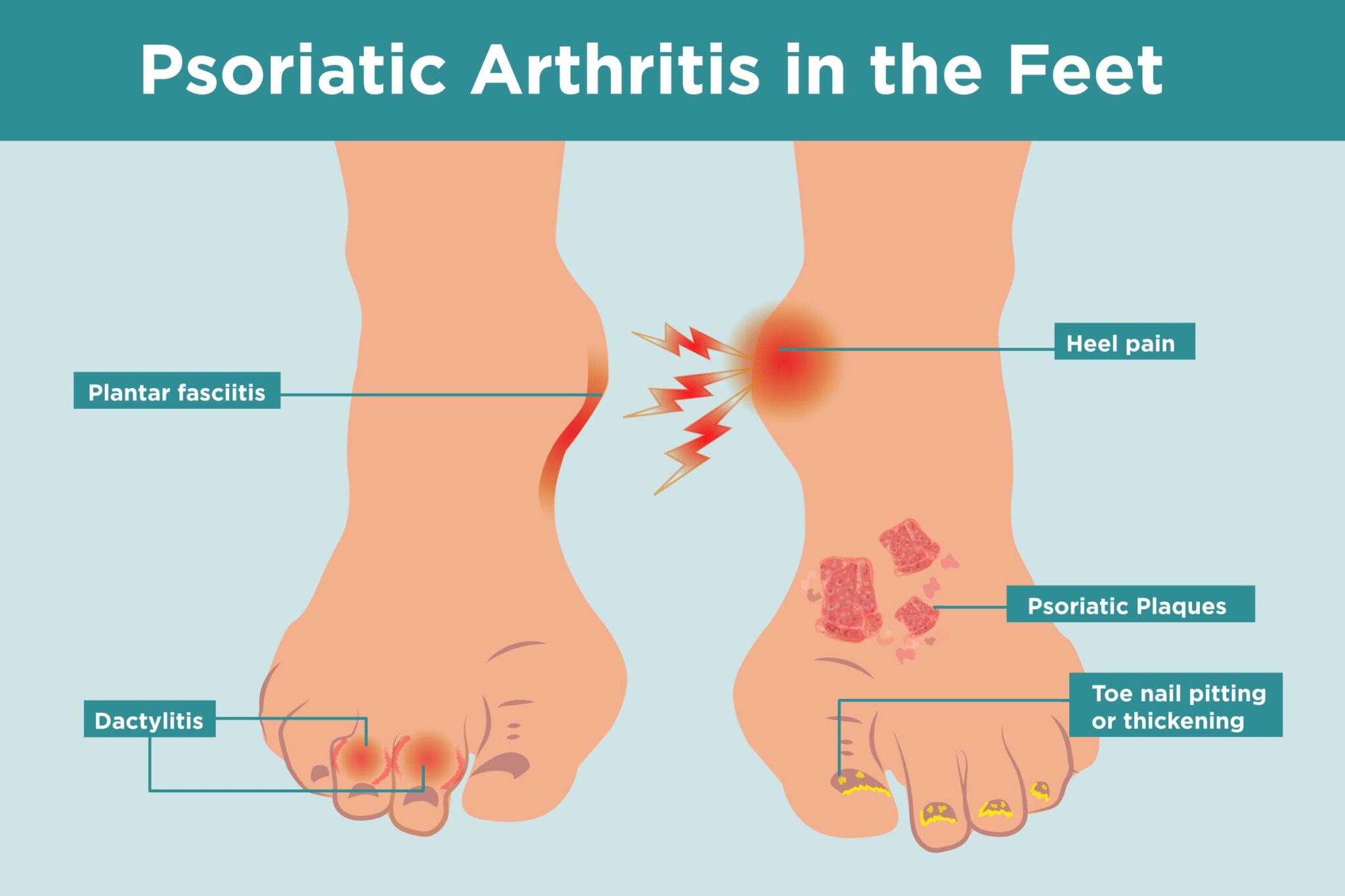 0519_Psoriatic-Arthritis-Feet