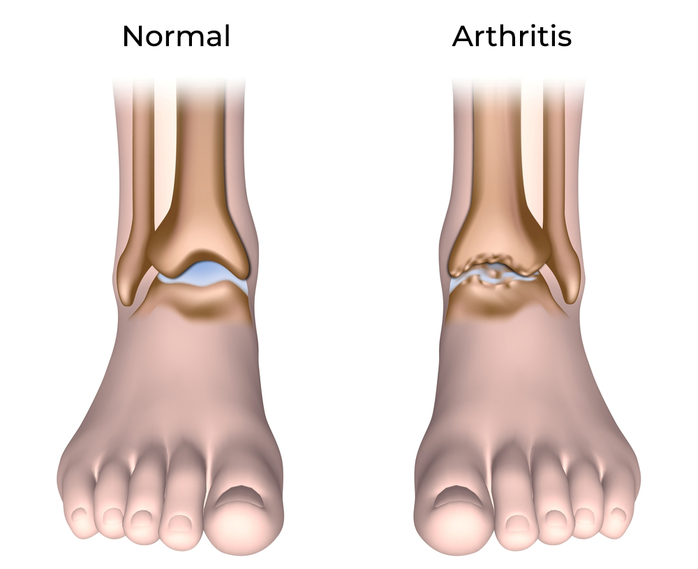 Foot-osteoarthritis
