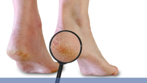 How to Treat and Prevent Heel Cracks