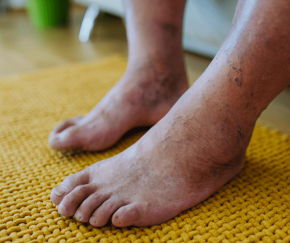 diabetic feet diabetic feet