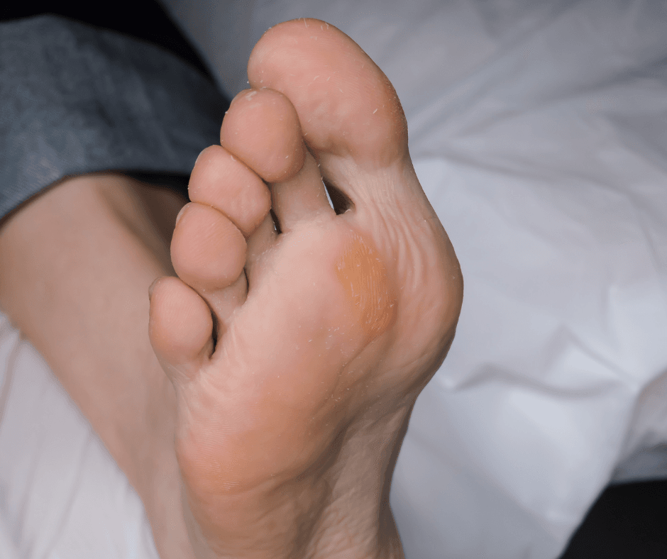 foot callus