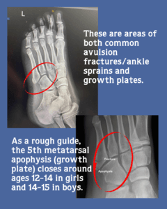 foot injury xray
