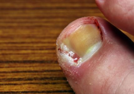 An ingrown toenail